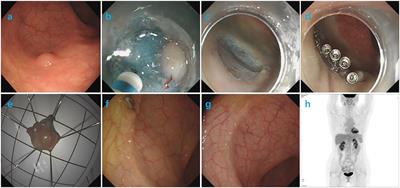 Successful Endoscopic Resection of Primary Rectal Mucosa-Associated Lymphoid Tissue Lymphoma by Endoscopic Submucosal Dissection: A Case Report